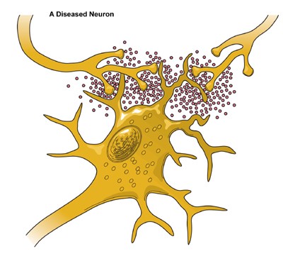 A diseased neuron